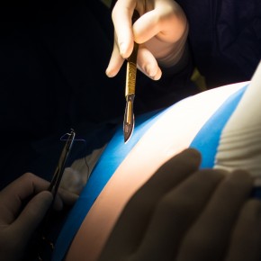 Incision chirurgicale Lutter contre la douleur est une priorité. Les techniques les plus modernes sont mises en oeuvre en améliorant continuellement la prise en charge de la douleur.